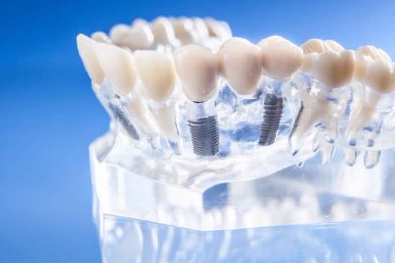 Galeriebild pirina-dental-implantatgetragene-kronen.jpg