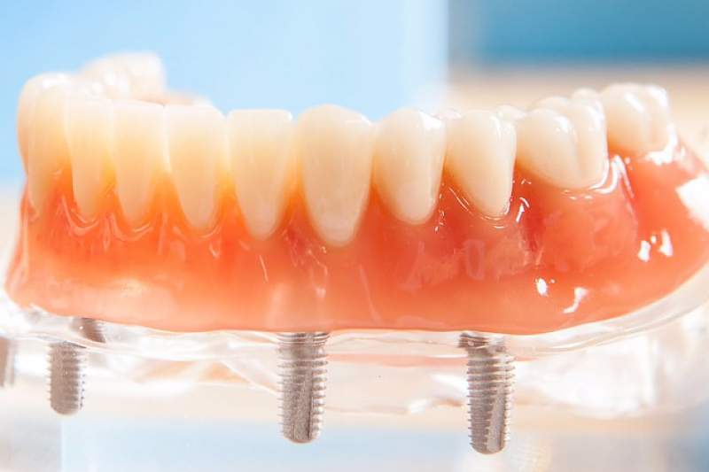 Galeriebild pirina-dental-zahnprothese